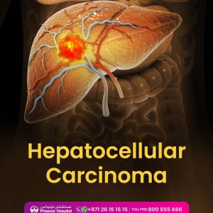 "Hepatocellular Carcinoma"